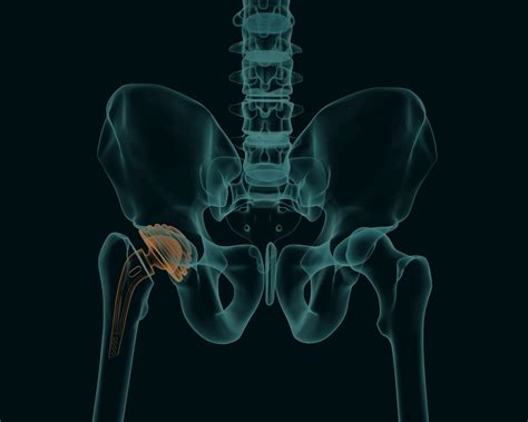 Hip Replacement Complications and Risks - Morris Law Firm