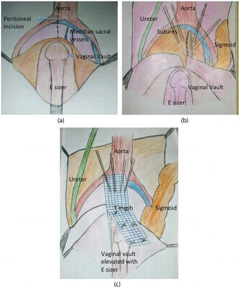 Recurrent Pelvic Organ Prolapse | IntechOpen