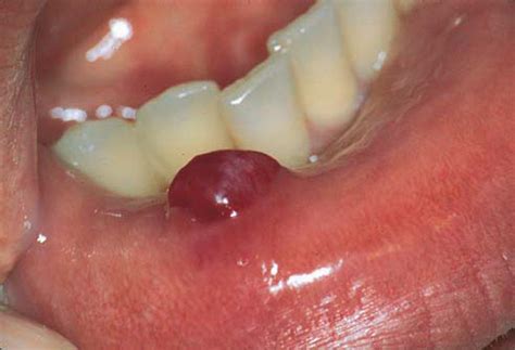 dentalaka: Mucocele, Ranula and Dermoid cyst-Short note