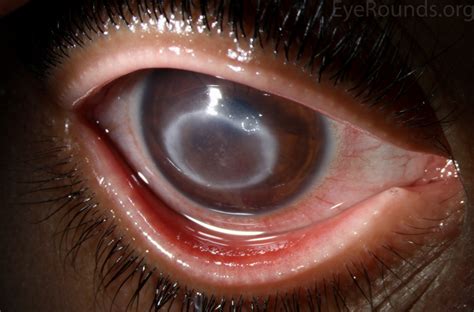 Atlas Entry - Acanthamoeba keratitis