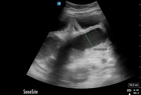 Small Bowel Obstruction 3 | Emory School of Medicine