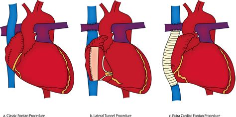 Perioperative Management of the Fontan Patient for Cardiac and ...