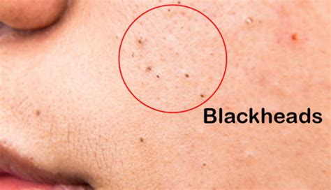 Blackheads: Causes, Symptoms, Prevention and Treatment - HealthyLopo