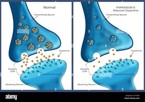 Labeled illustration showing low levels of the neurotransmitter Stock Photo: 103992493 - Alamy