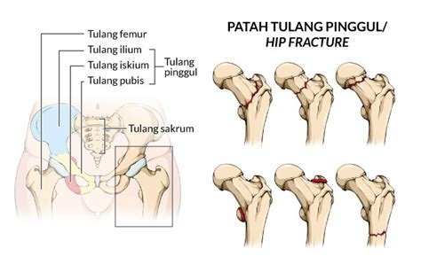 Patah Tulang Pinggul - Gejala, penyebab dan mengobati - Alodokter