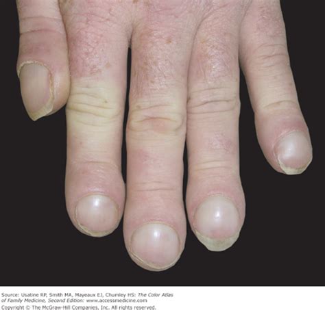 Top 100+ Pictures What Does Clubbing Of The Fingers Look Like Updated