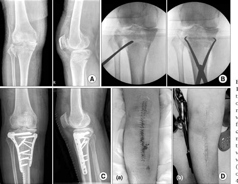 Table 2 from Treatment of Schatzker Type V and VI Tibial Plateau ...