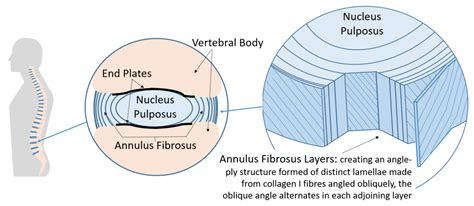 Bioengineering | Free Full-Text | Lumbar Intervertebral Disc Herniation: Annular Closure Devices ...