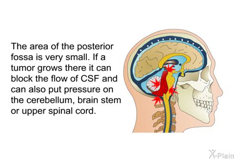 PatEdu.com : Posterior Fossa Craniotomy for Brain Tumors