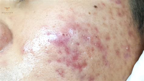 Pop bleakheads,acne,cysts carefully at Hien Van Spa-408-Duy Tan - YouTube