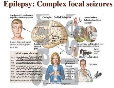 epilepsy