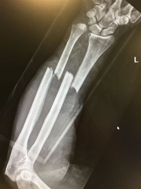 Distal Radial Ulnar Joint (DRUJ) Injuries - Trauma - Orthobullets