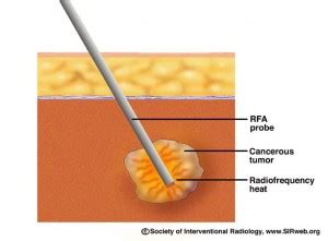 Radiofrequency Ablation