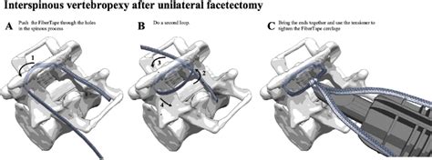 Schematic illustrations of the interspinous vertebropexy after... | Download Scientific Diagram