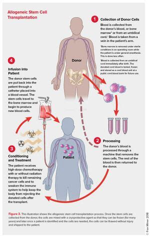 Physiotherapy in Stem Cell Transplantation - Physiopedia