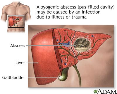 Pyogenic liver abscess Information | Mount Sinai - New York