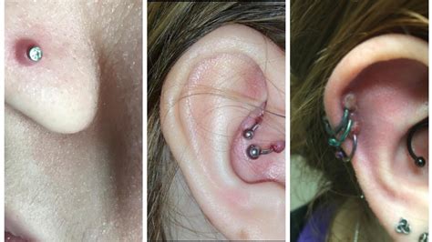 What Is A Keloid? Piercing Hypertrophic Scars Explained, 43% OFF