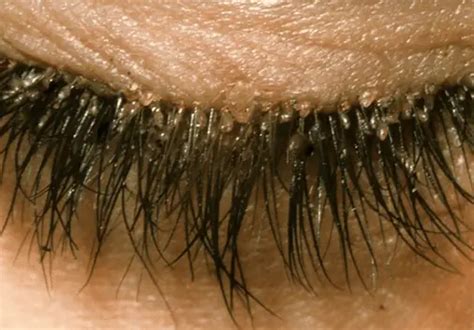 Eyelash Mites Causes, Symptoms, in Humans, Pictures, Mascara, Eyebrow, Treatment, Get Rid ...