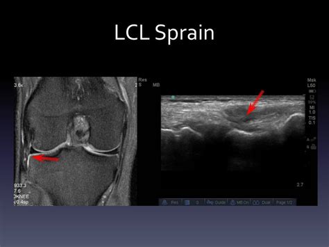 Ultrasound - Knee