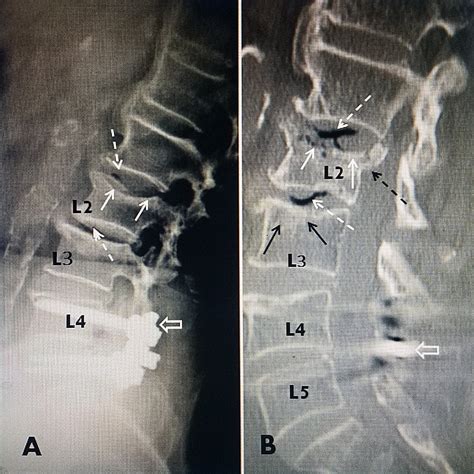 Cureus | Radiologic Evaluation of Chronic Vertebral Compression Fractures and Role of Vertebral ...