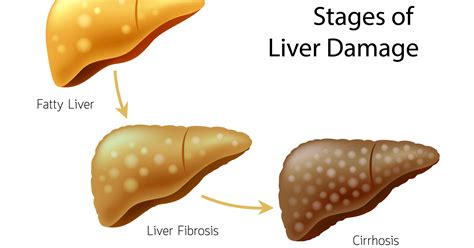 I was diagnosed with fatty liver disease. What is it, and is this serious? - Hep