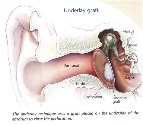 Myringoplasty (repairing a hole in the ear drum) - Dr Bridget Clancy | ENT Surgeon