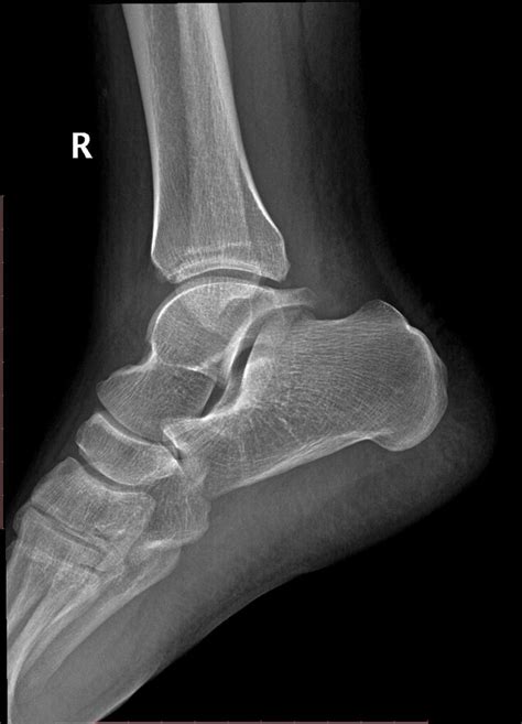 Posterior ankle impingement | Radiology Case | Radiopaedia.org | Radiology | Radiology, Ankle ...