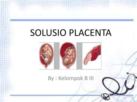 Solusio placenta | PPT