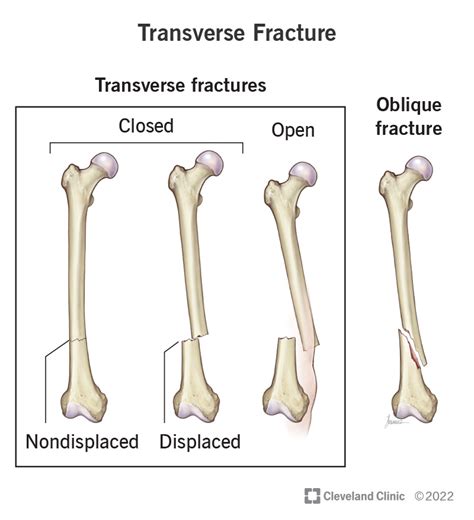 Transverse Process Fracture