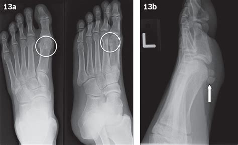 Common accessory ossicles of the foot: imaging features, pitfalls and ...