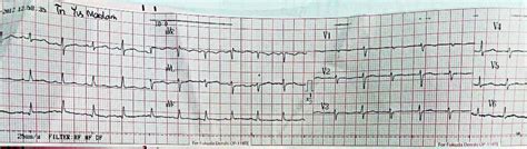 Electrical alternans patterns on ECG. | Download Scientific Diagram