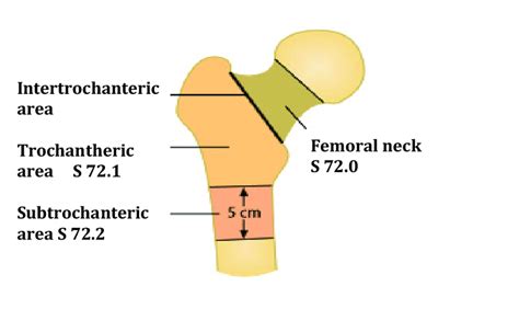 The classification of the upper end of the femur fractures (ICD 10)... | Download Scientific Diagram