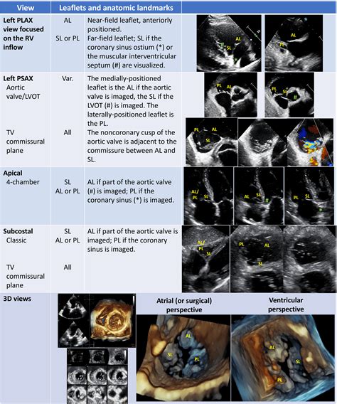 Multi-Modality Imaging of the Tricuspid Valve: From Tricuspid Valve ...