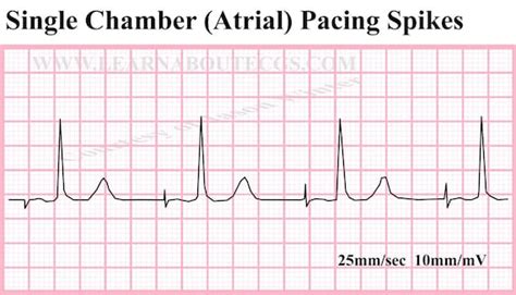 Items similar to Single Chamber (Atrial) Pacing Spikes ECG Strip. on Etsy