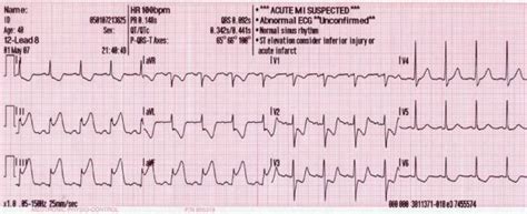 The Importance of Reciprocal Changes in Lead aVL