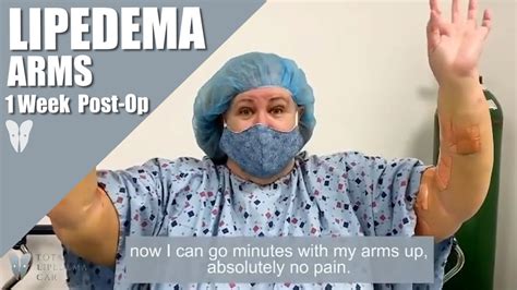 Lipedema Reduction Surgery: Arms | One-Week Post-Op | Liposuction ...