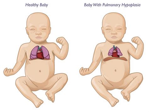 Pulmonary hypoplasia causes, symptoms, diagnosis, treatment & prognosis