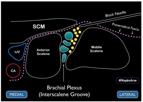 Ultrasound-Guided Interscalene Brachial Plexus Nerve Block – Core EM