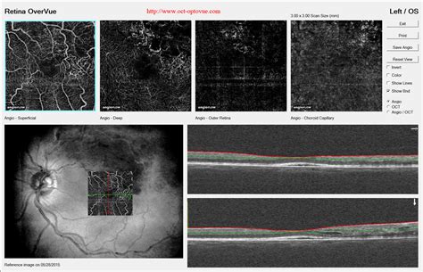 OCT angiography & vascular diseases