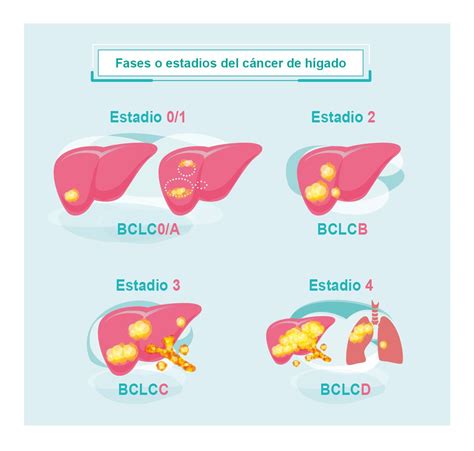 Fases o estadios del cáncer de hígado | Roche Pacientes