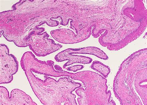 Thyroglossal Duct Cyst Histology