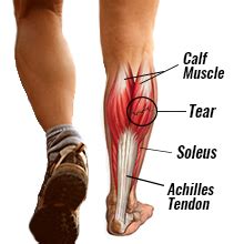 Calf muscle strain- cause, symptoms and treatment.