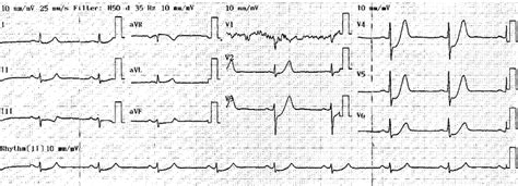 In a patient with acute coronary syndrome, 12-lead ECG shows diffuse ST... | Download Scientific ...