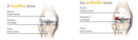 Mako for Total Knee replacement - ALBJC