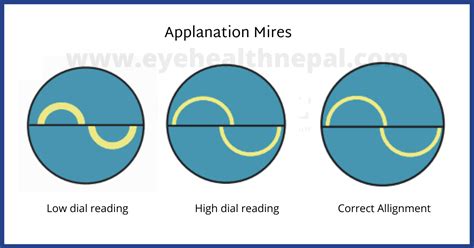 How To Measure Intraocular Pressure - Eye Health Nepal