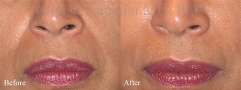 Fillers for Nasolabial Folds & Smile Lines - Boston Eyelids