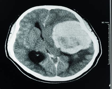 Can a CT Scan Detect a Brain Tumor? » Scary Symptoms