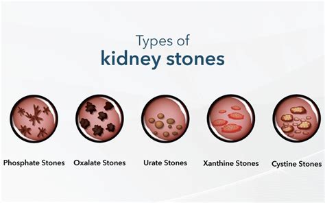 Behind the pain: The warning signs of Kidney Stones Symptoms