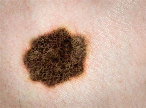 Melanoma Treatment After Diagnosis