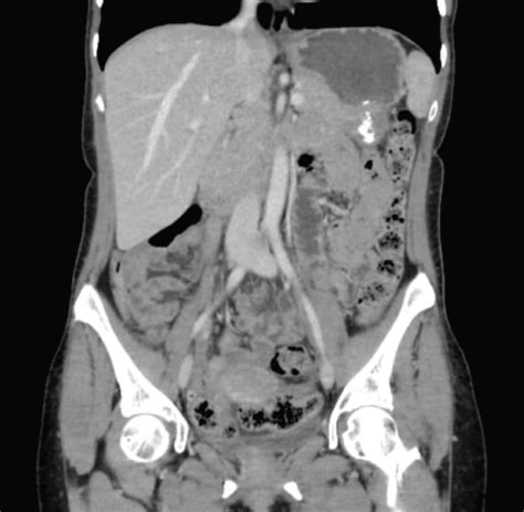 Peritoneal Carcinomatosis from Ovarian Cancer: A Case Report | Fulltext | IgMin Research - STEM ...